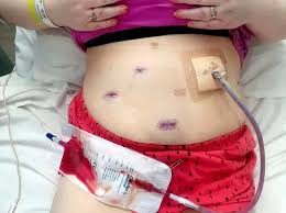 laparoscopic wound site stomach