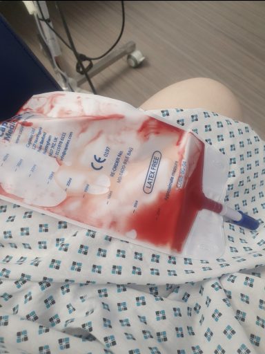 Drain bag showing blood after surgical washout